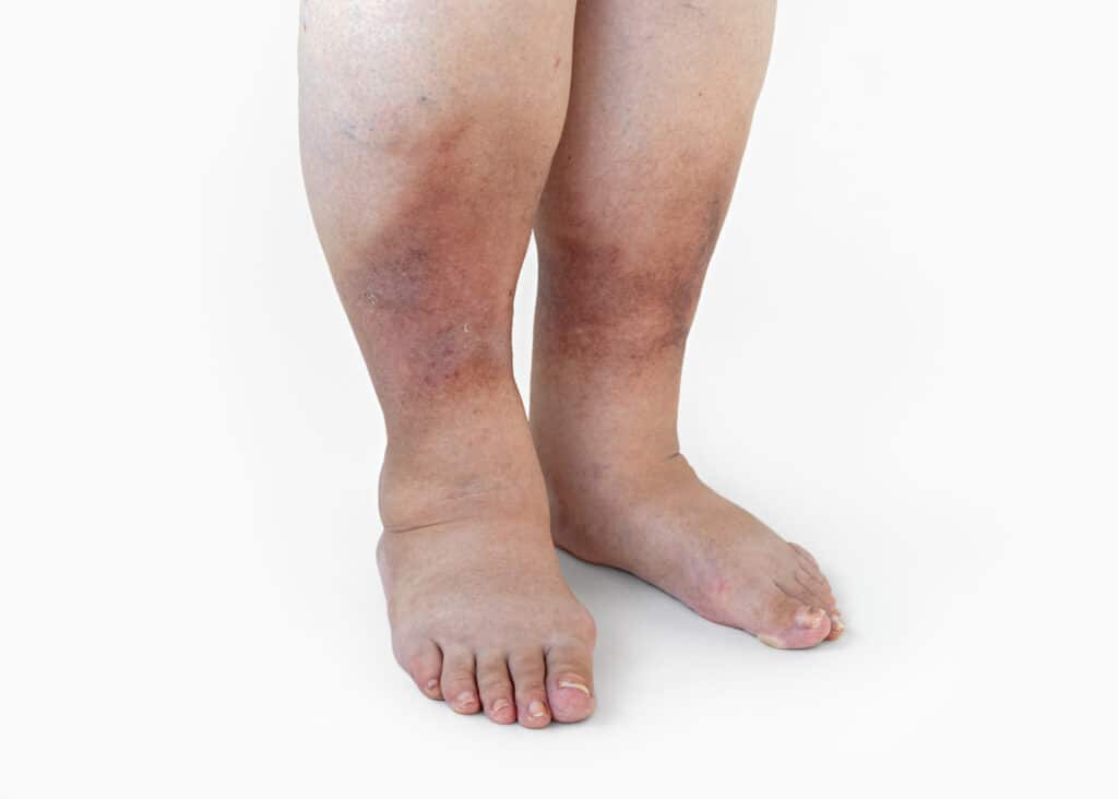Edema Anatomy