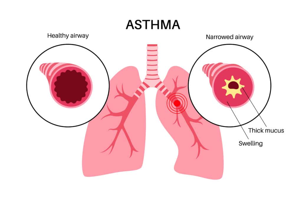 Asthma Anatomy