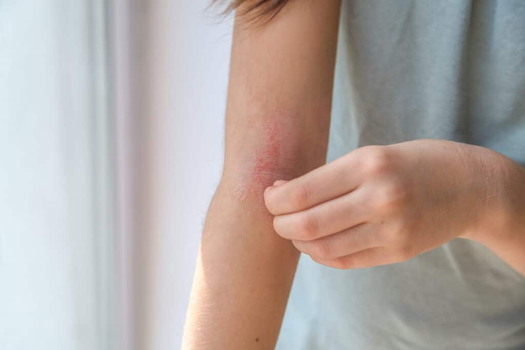 Eczema Anatomy