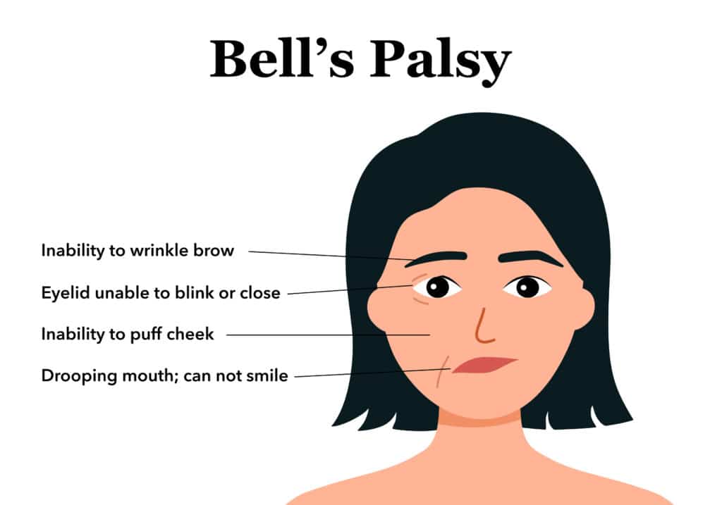 Bell's Palsy Anatomy