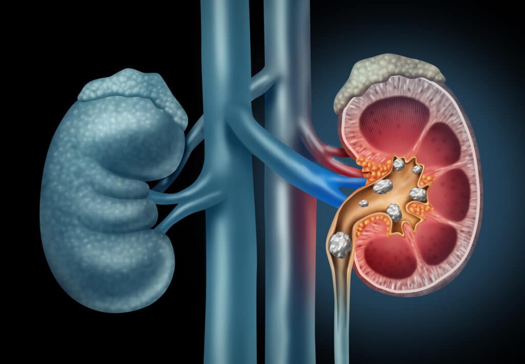 Kidney Stones Anatomy