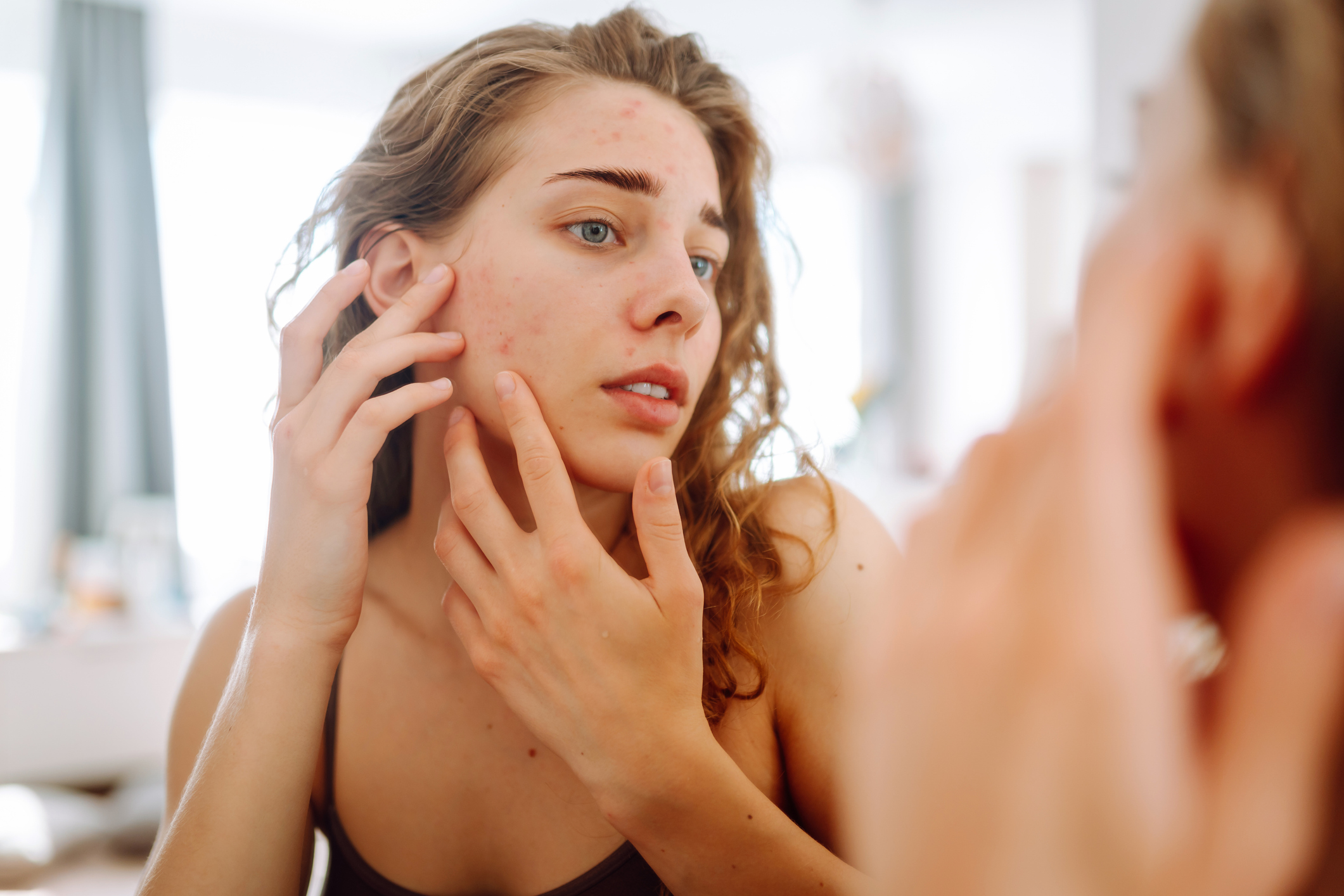 Does Acne Go Away on Its Own?