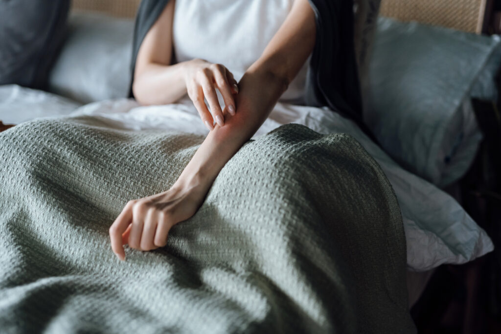 Eczema Symptoms