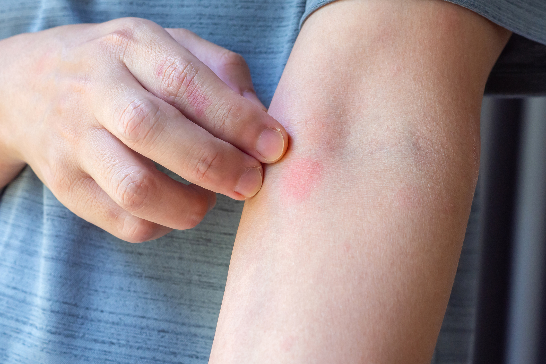 Atopic Dermatitis Symptoms