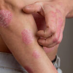 What to Avoid with Eczema