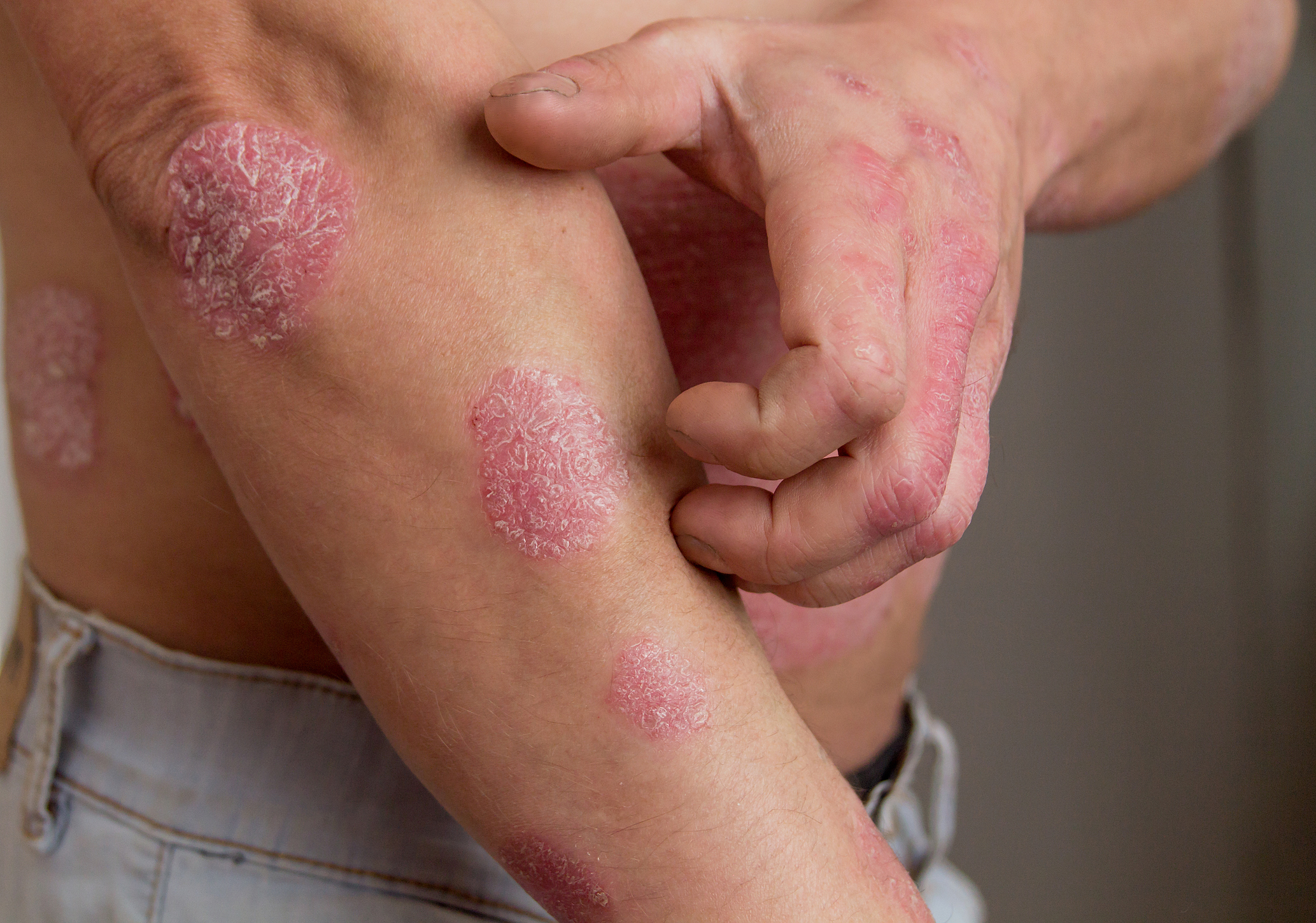 What to Avoid with Eczema