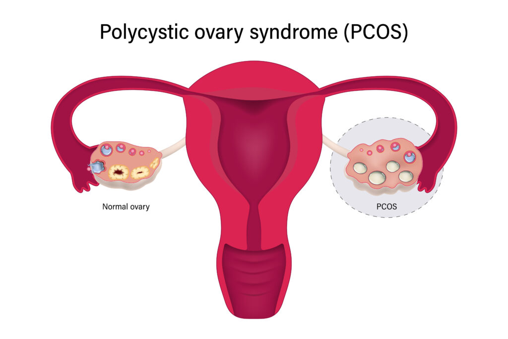 PCOS Anatomy