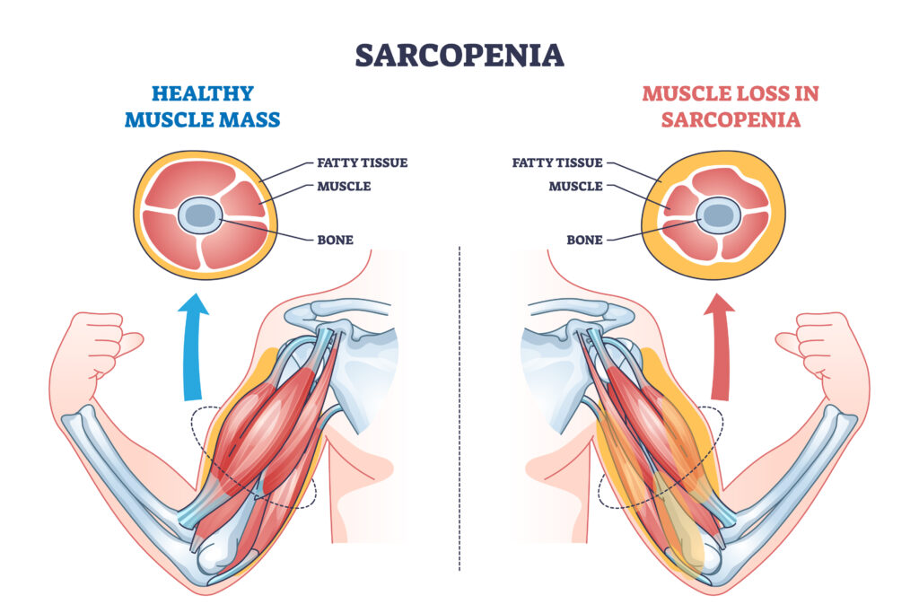 Sarcopenia Anatomy