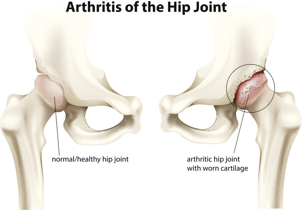 Hip Osteoarthritis Anatomy