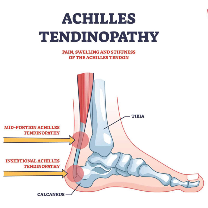 Achilles tendinopathy diagram.