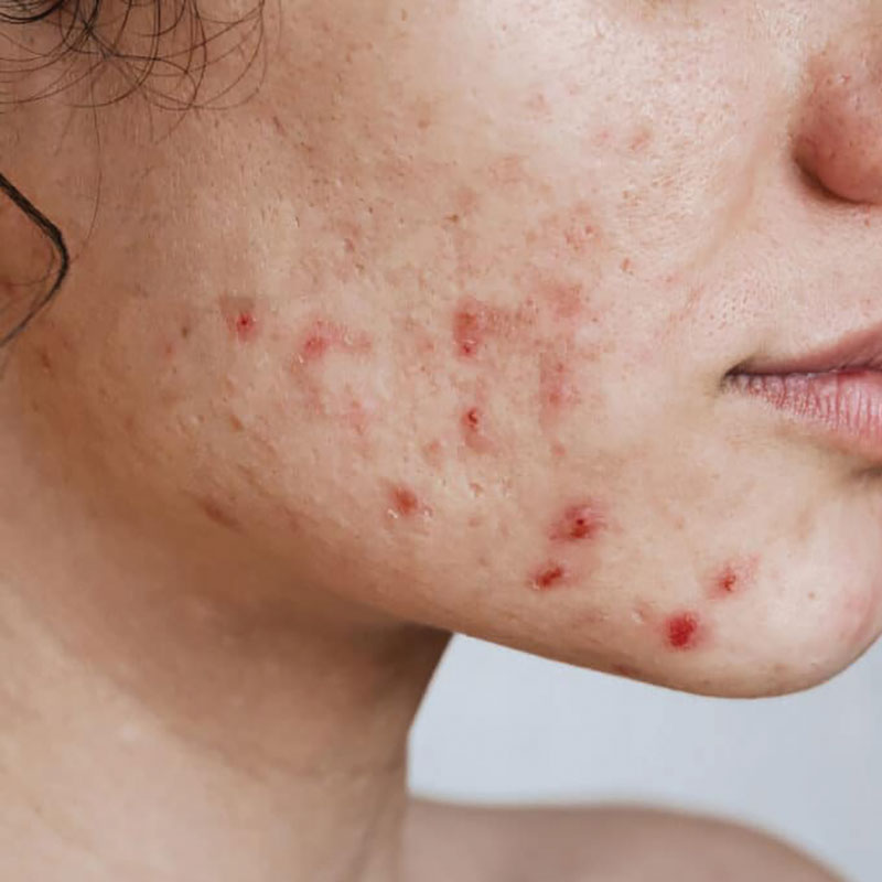 acne on face