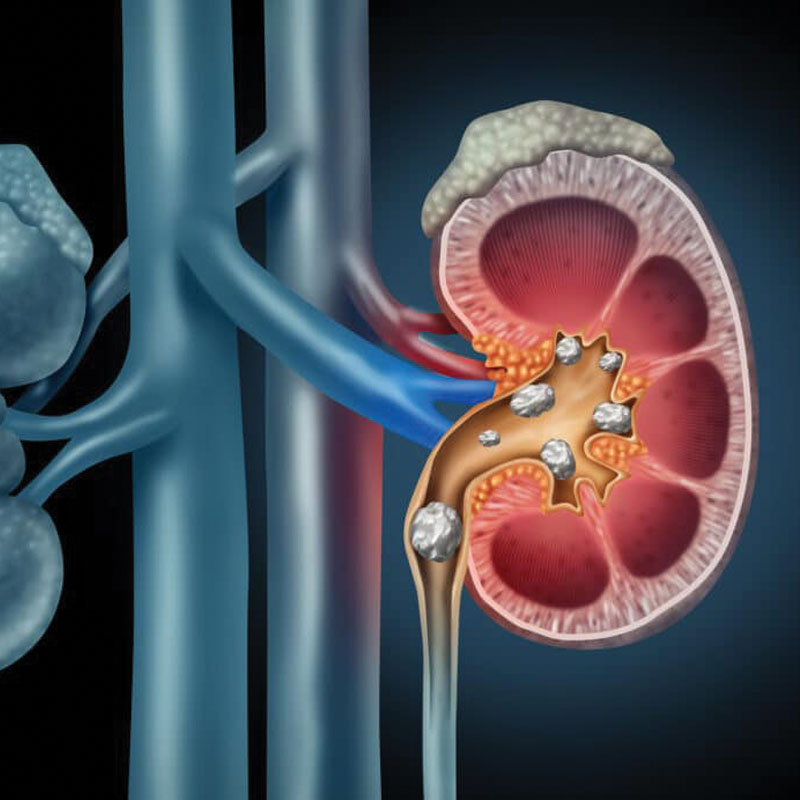 anatomical diagram of kidney stones