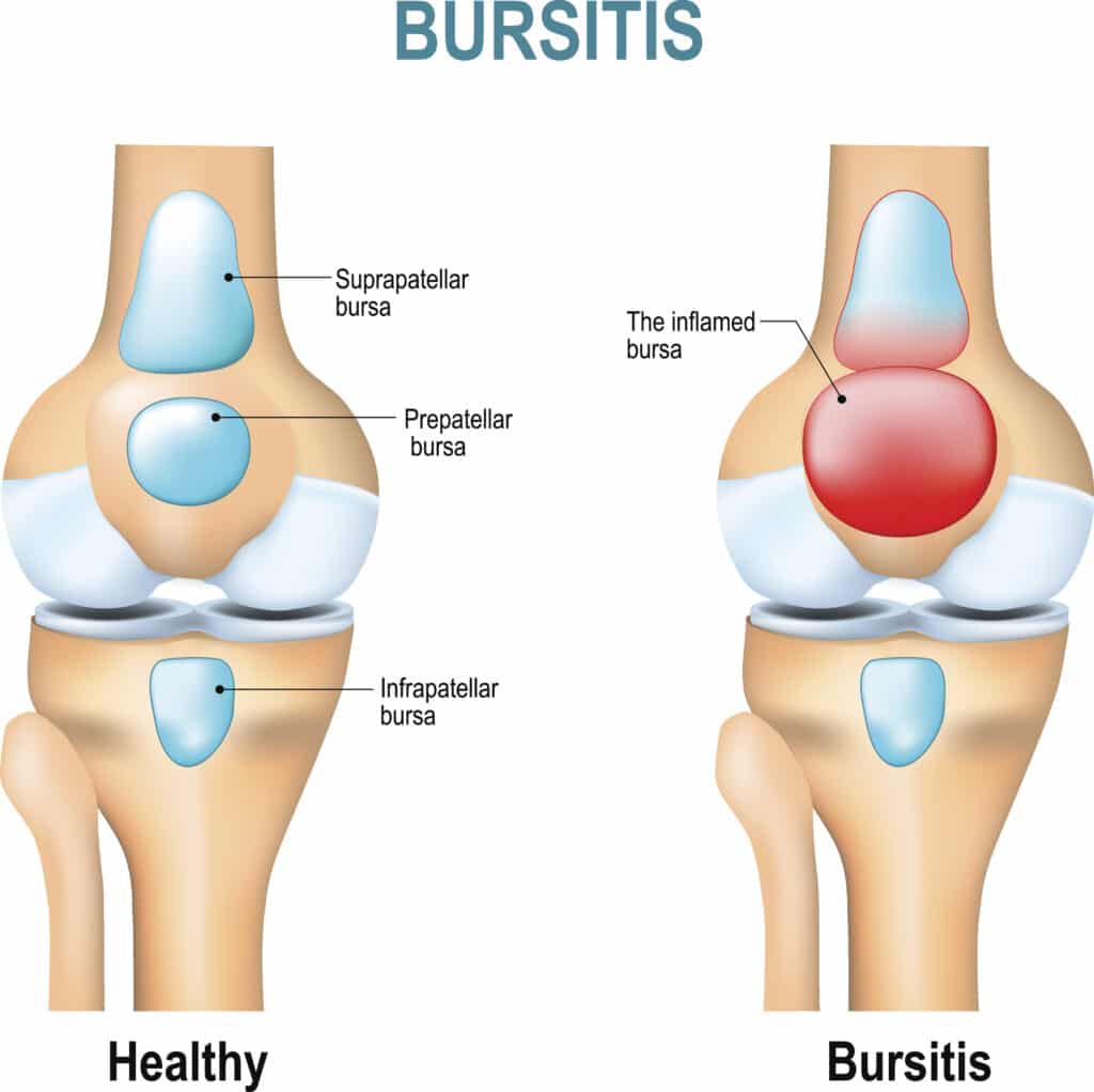 anatomical diagram of knee bursitis