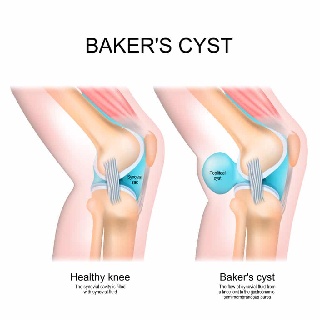 baker's cyst diagram