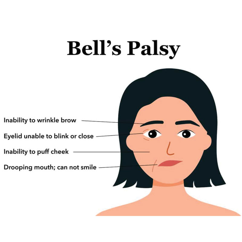 bell's palsy diagram
