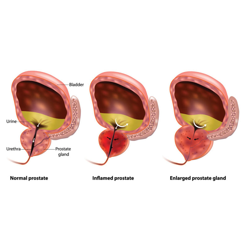 diagram of benign prostate hypertrophy
