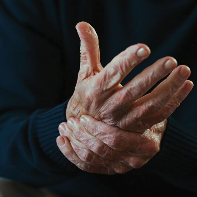 hands with complex regional pain syndrome