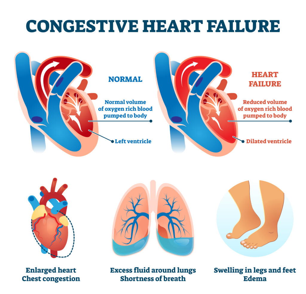 diagram of congestive heart failure