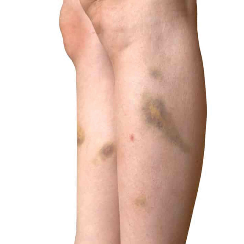 contusions on legs