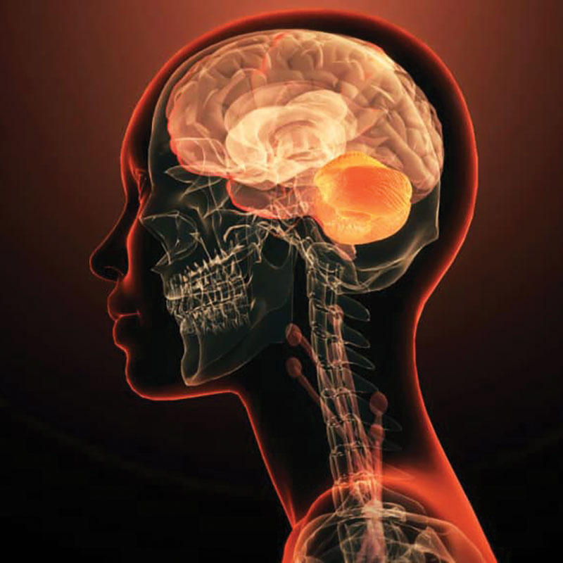 graphical depiction of cerebral palsy