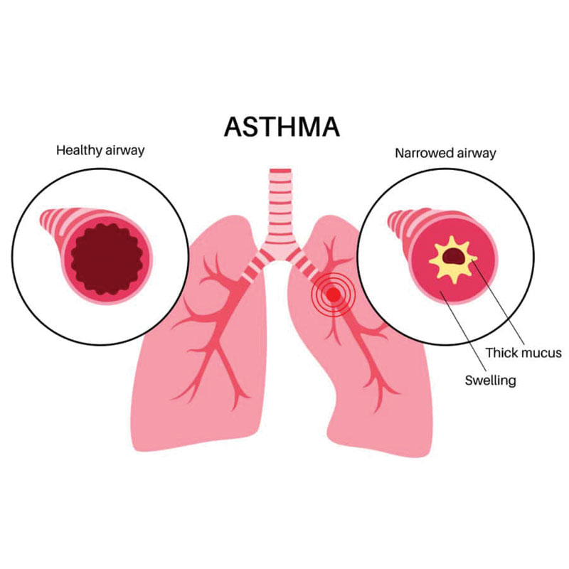 diagram of asthma