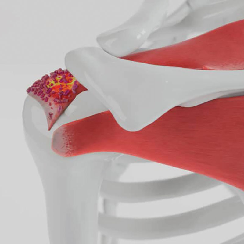 diagram of calcific tendonitis