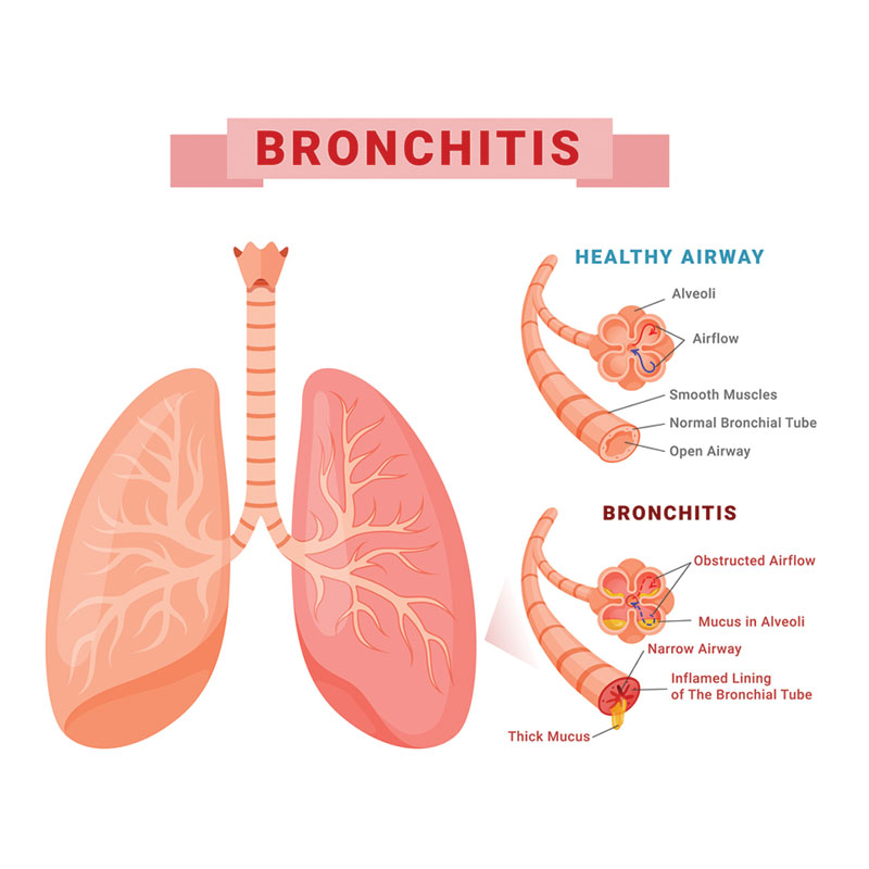 diagram of chronic bronchitis