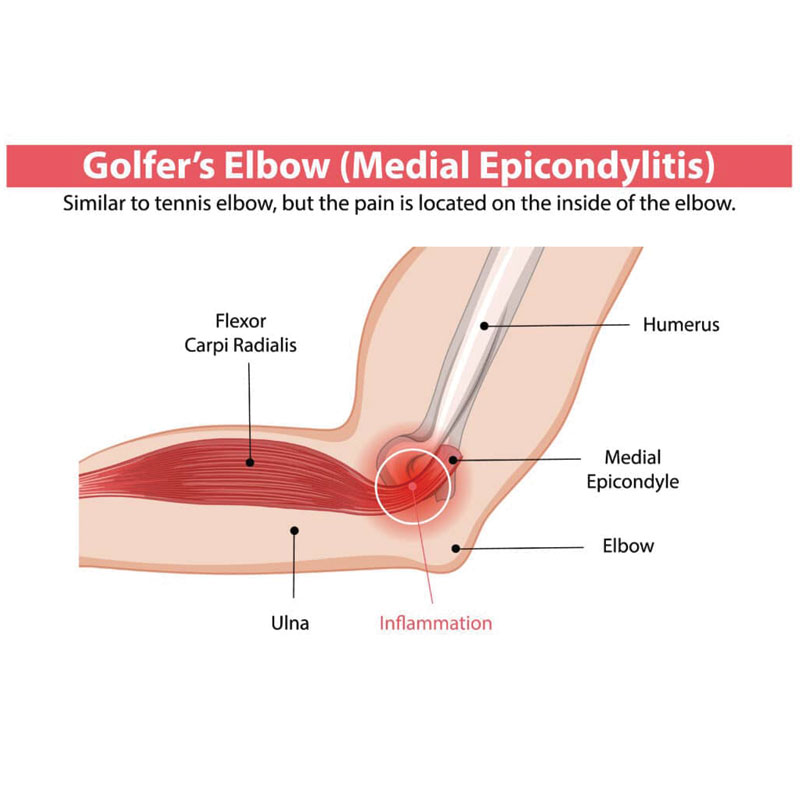 anatomical diagram of golfer's elbow