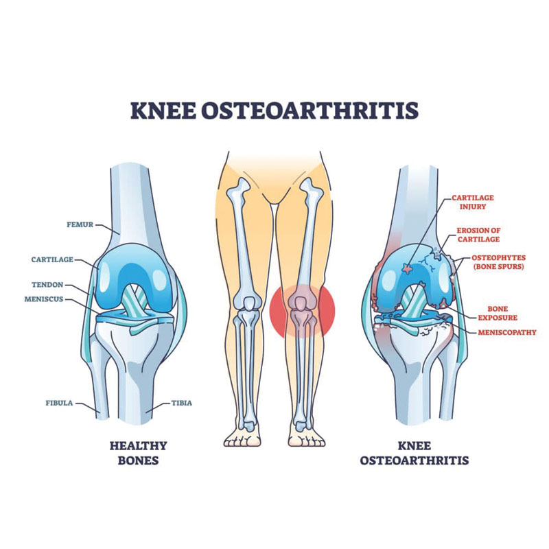 anatomical diagram of knee osteoarthritis