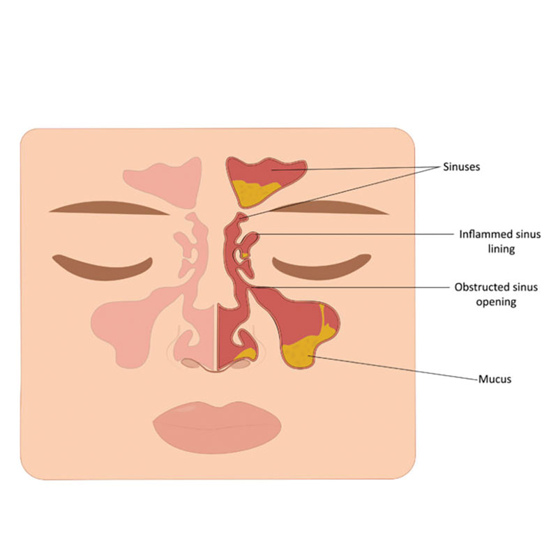 diagram of rhinosinusitis
