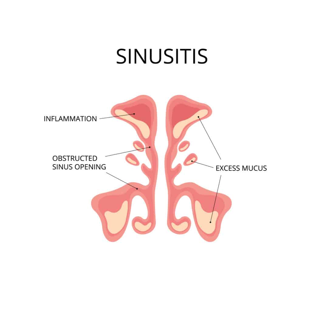 diagram of chronic sinusitis