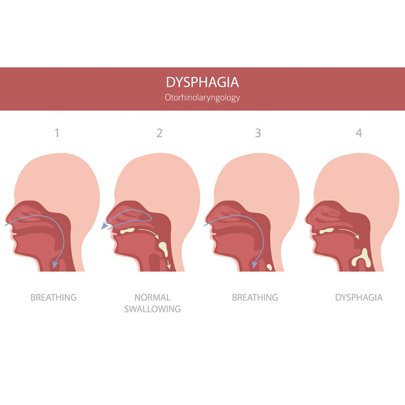 diagram of dysphagia