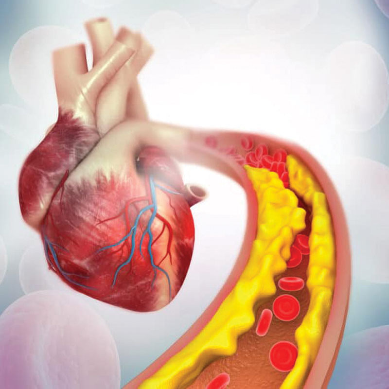 graphic depicting high cholesterol