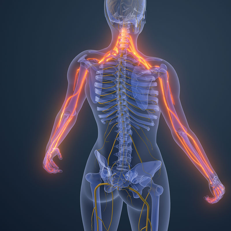 graphic showing cervical radiculopathy