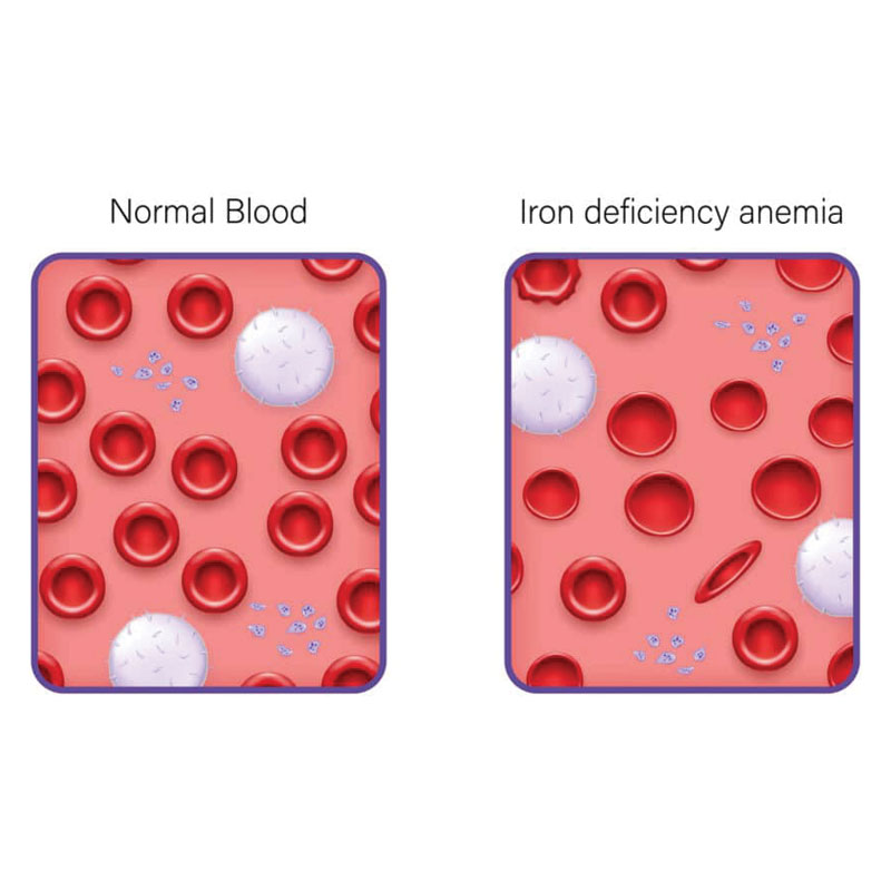 diagram of iron deficiency