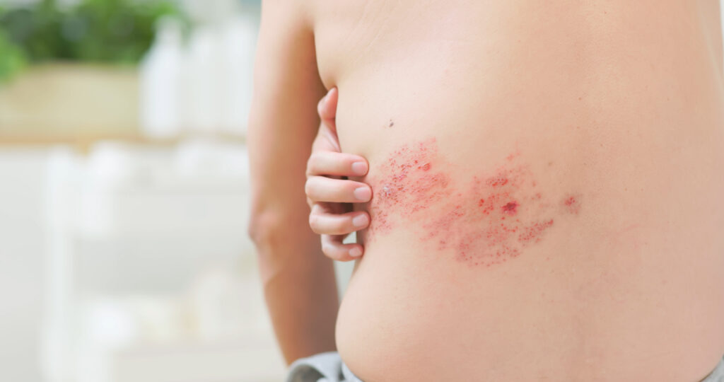 Shingles