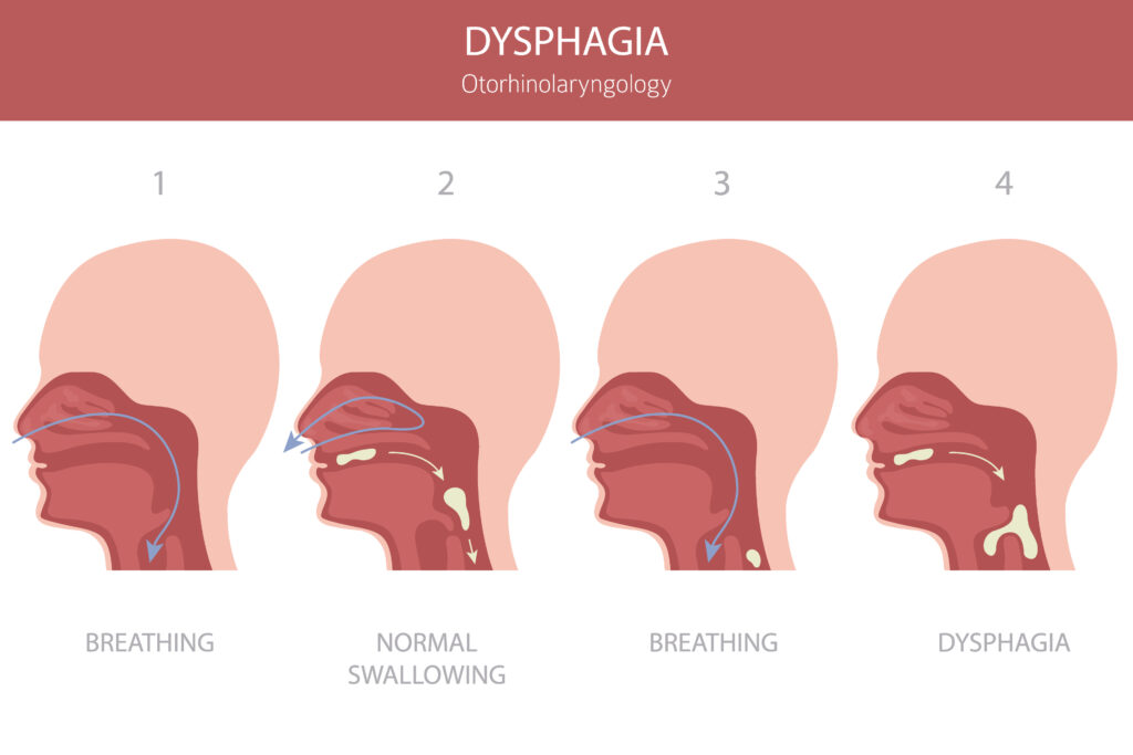 Dysphagia Anatomy