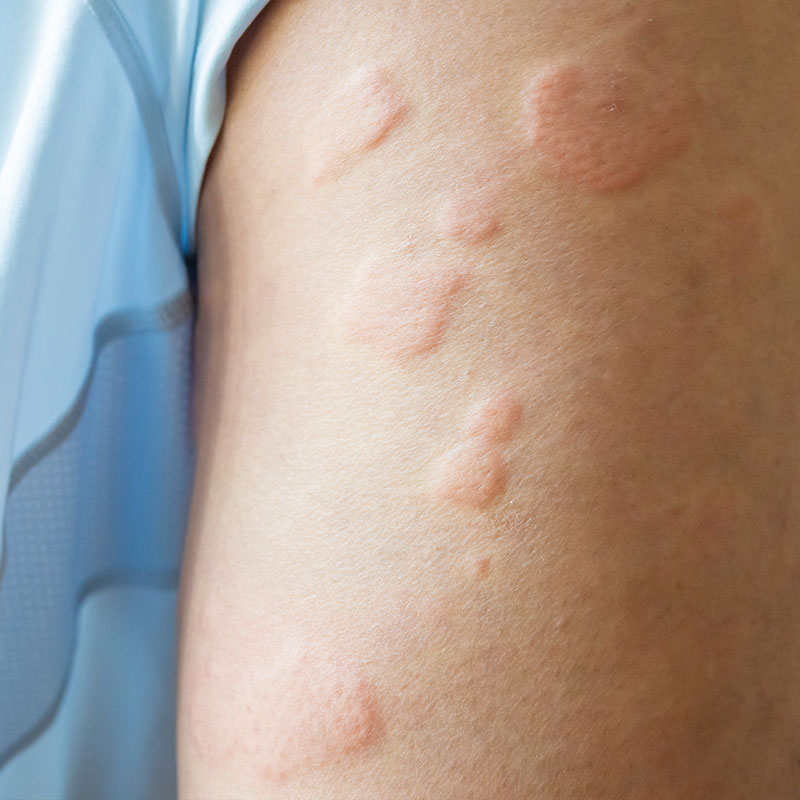 idiopathic urticaria on arm
