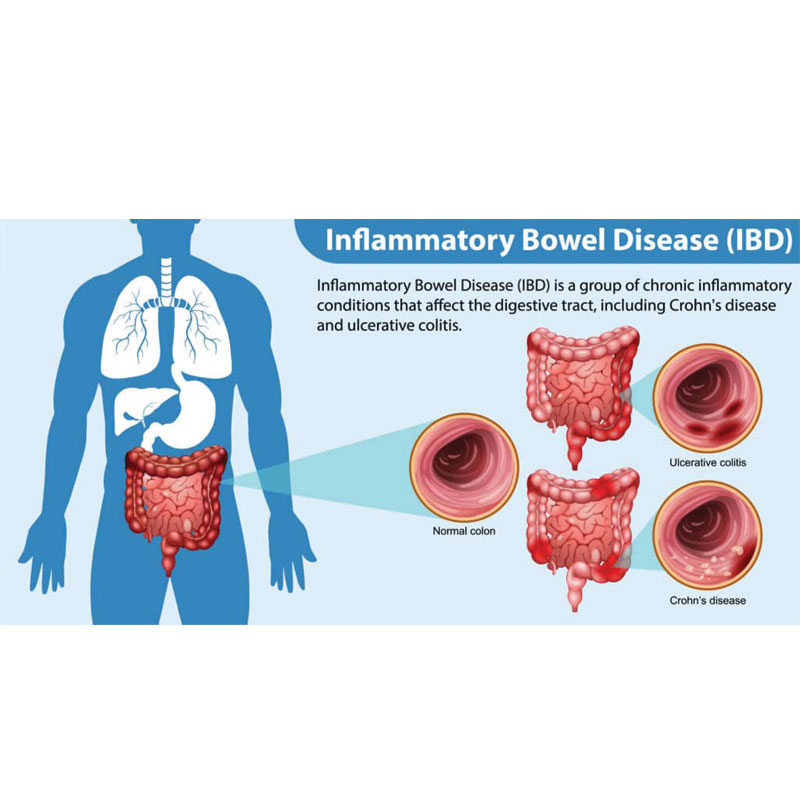 graphic showing inflammatory bowel disease