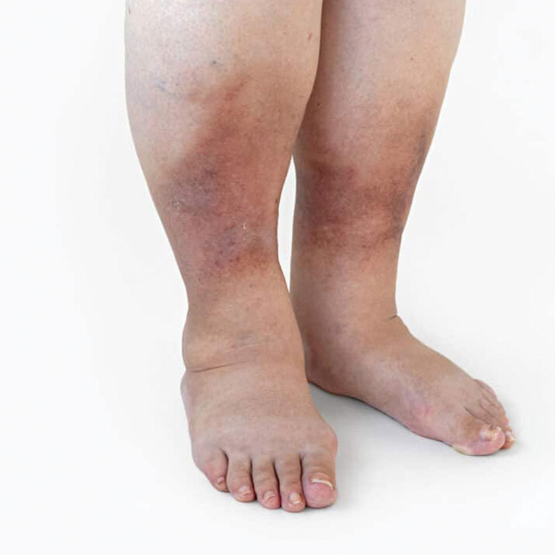 legs with edema