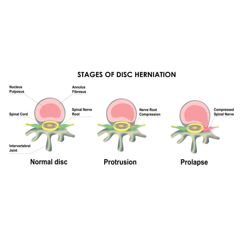 diagram showing the stages of cervical disc herniation