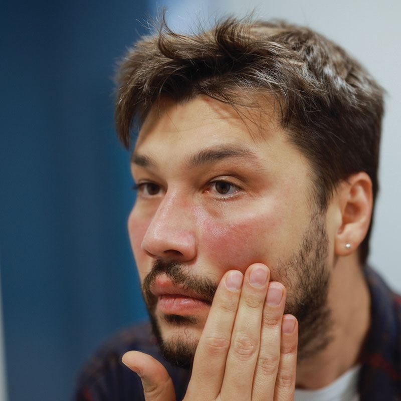 young man with eczema