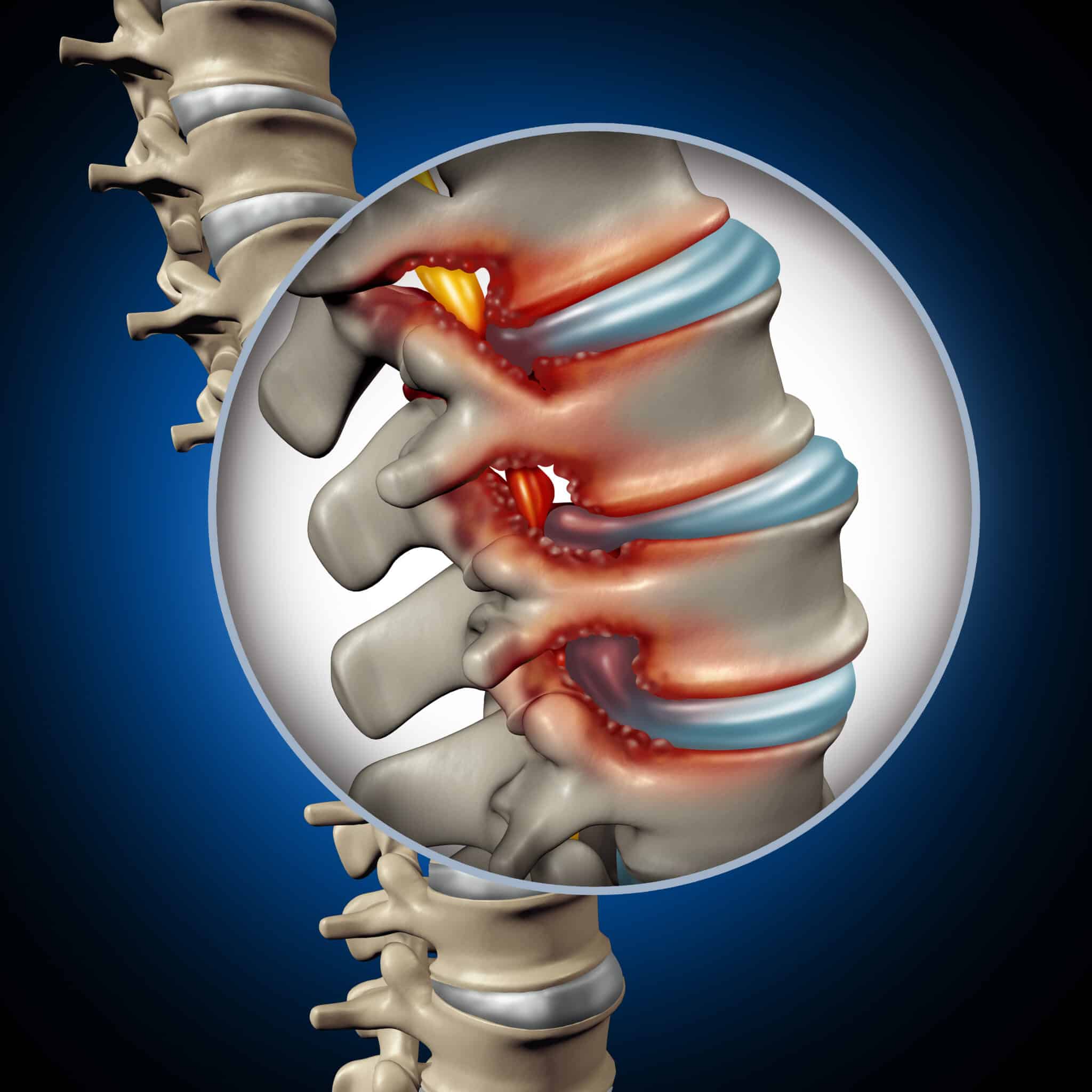 anatomical image of spinal stenosis