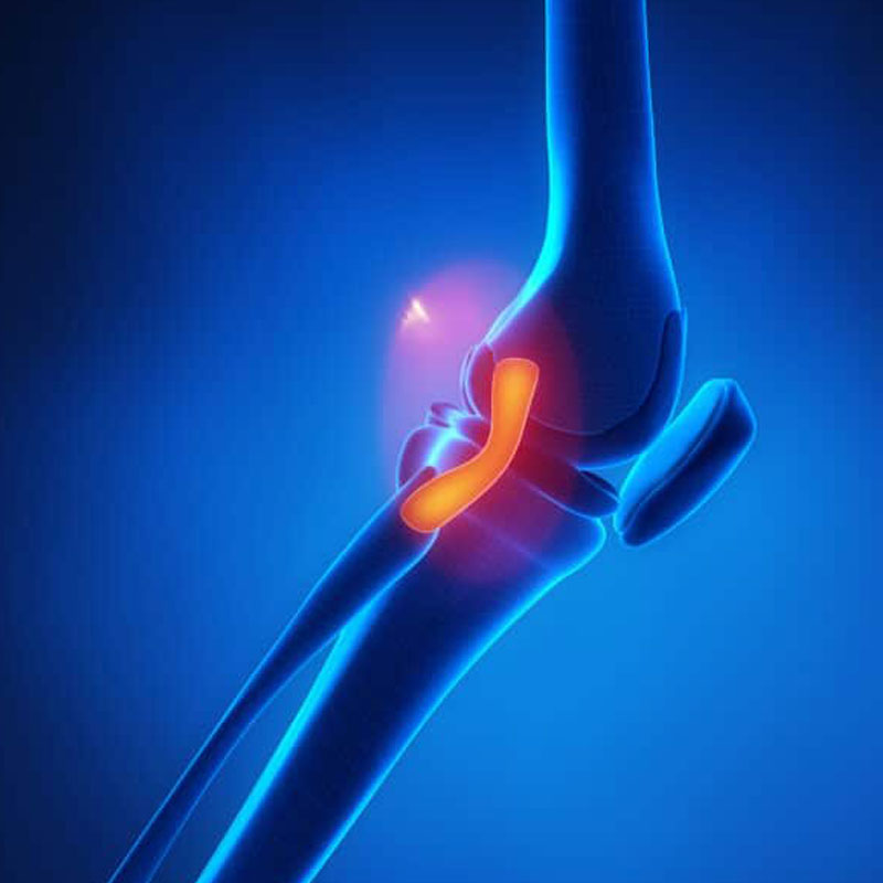 graphic showing an lcl sprain