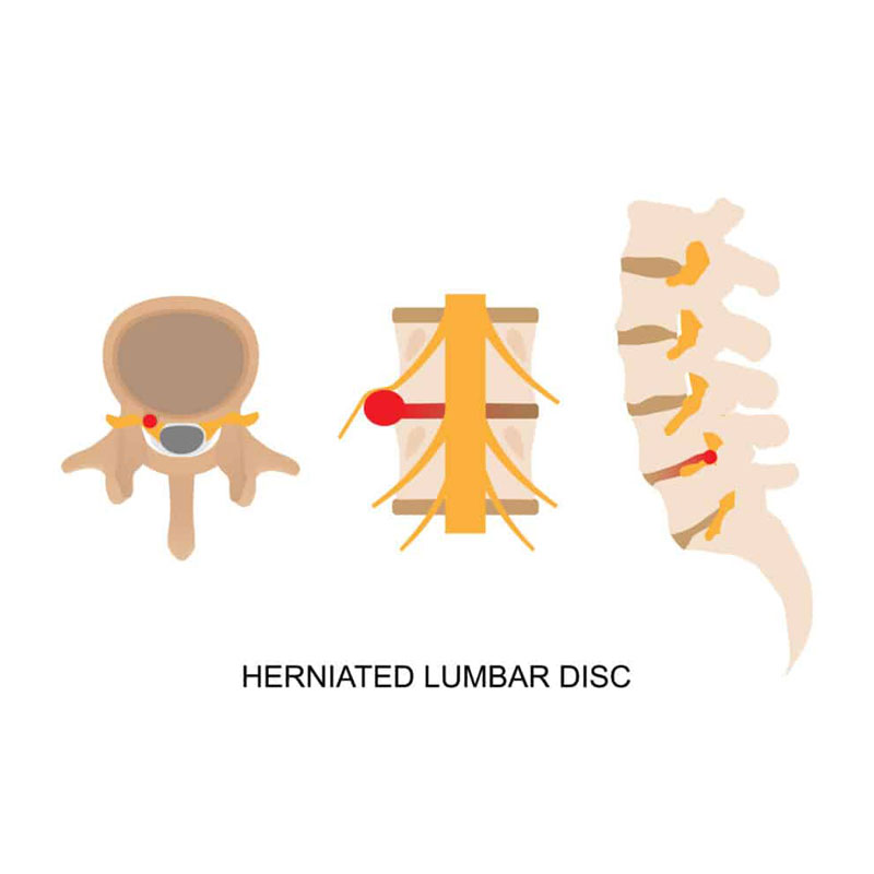 diagram showing lumbar disc herniation