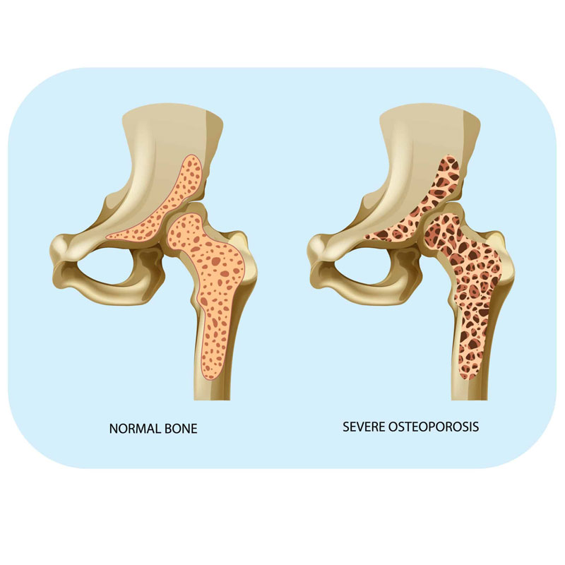 diagram of osteoporosis