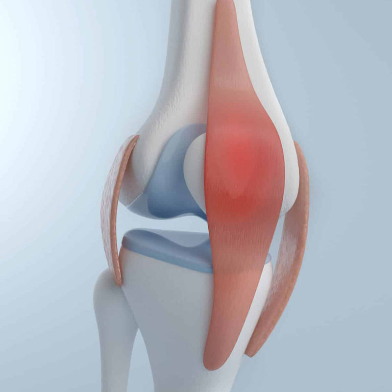 diagram of patellar tendinopathy