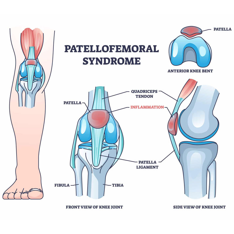 diagram of patellofemoral pain syndrome