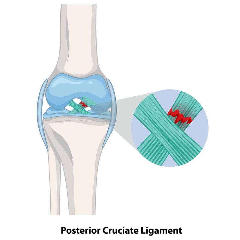 diagram of pcl sprain