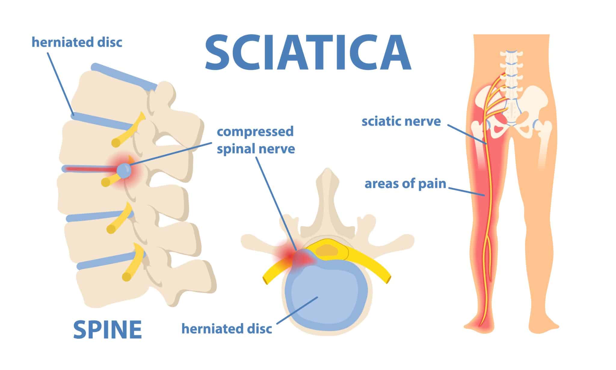diagram of sciatcia